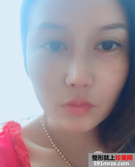 又去时光整形医院做了自体隆鼻 价格和恢复效果图