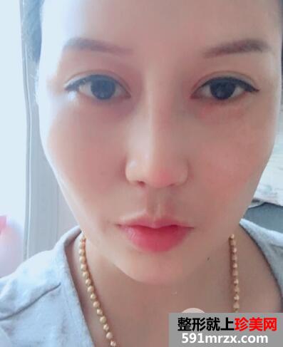 又去时光整形医院做了自体隆鼻 价格和恢复效果图