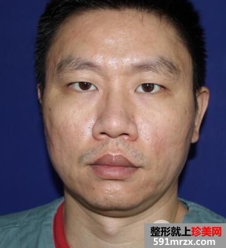 男士切开双眼皮开内眼角一个月恢复自然 价格和图片