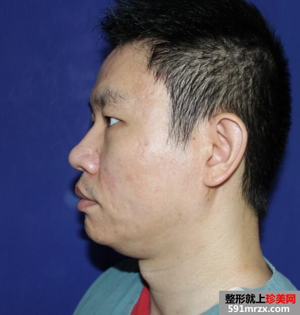 男士切开双眼皮开内眼角一个月恢复自然 价格和图片