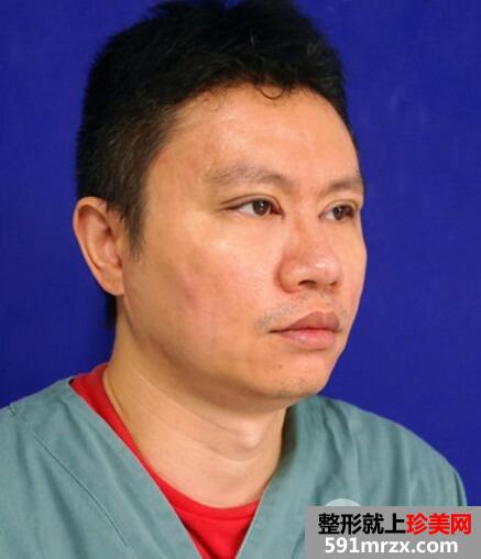 男士切开双眼皮开内眼角一个月恢复自然 价格和图片