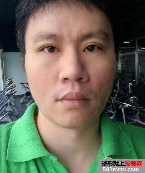 男士切开双眼皮开内眼角一个月恢复自然 价格和图片