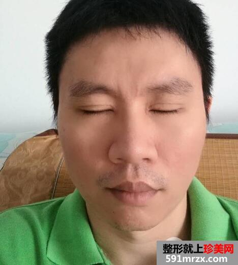 男士切开双眼皮开内眼角一个月恢复自然 价格和图片