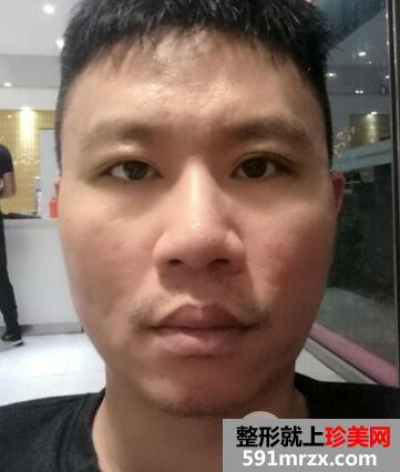 男士切开双眼皮开内眼角一个月恢复自然 价格和图片