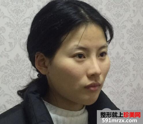脸部凹陷做脸部脂肪填充好吗？多少钱？真人案例多对比照片