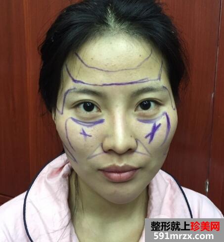 脸部凹陷做脸部脂肪填充好吗？多少钱？真人案例多对比照片