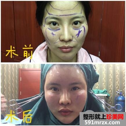 脸部凹陷做脸部脂肪填充好吗？多少钱？真人案例多对比照片