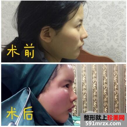 脸部凹陷做脸部脂肪填充好吗？多少钱？真人案例多对比照片