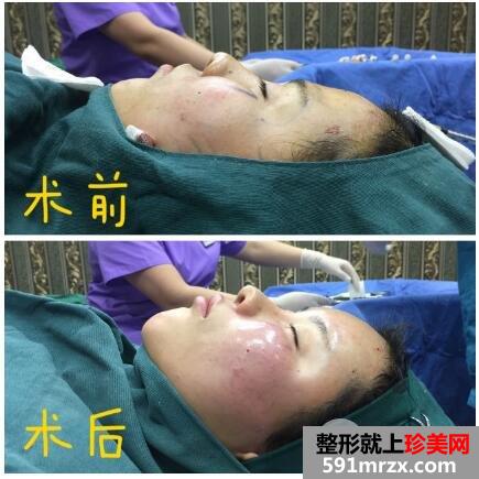 脸部凹陷做脸部脂肪填充好吗？多少钱？真人案例多对比照片