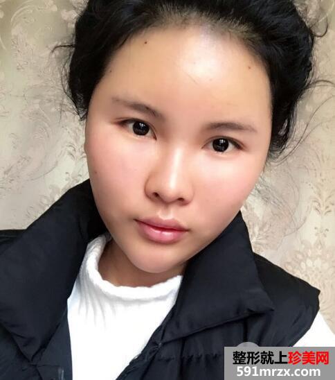 脸部凹陷做脸部脂肪填充好吗？多少钱？真人案例多对比照片