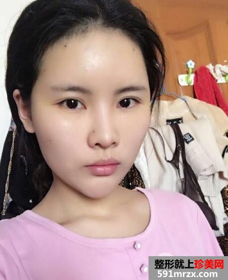 脸部凹陷做脸部脂肪填充好吗？多少钱？真人案例多对比照片