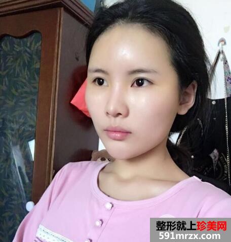 脸部凹陷做脸部脂肪填充好吗？多少钱？真人案例多对比照片