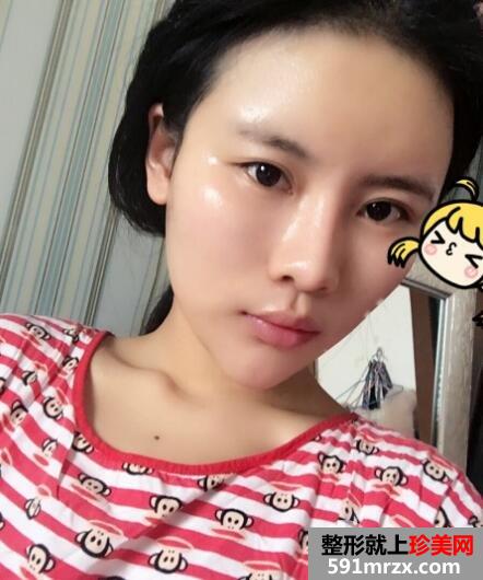 脸部凹陷做脸部脂肪填充好吗？多少钱？真人案例多对比照片