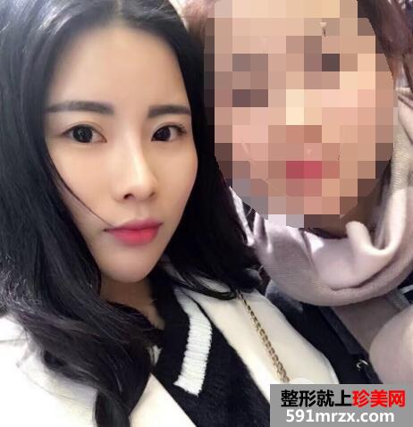 脸部凹陷做脸部脂肪填充好吗？多少钱？真人案例多对比照片