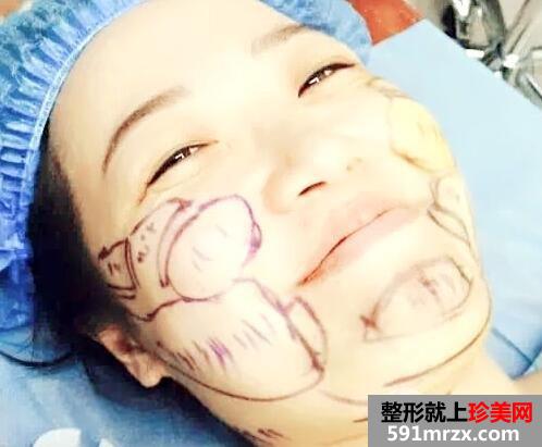 华美医院做的面部吸脂效果好恢复过程图和价格 真实案例