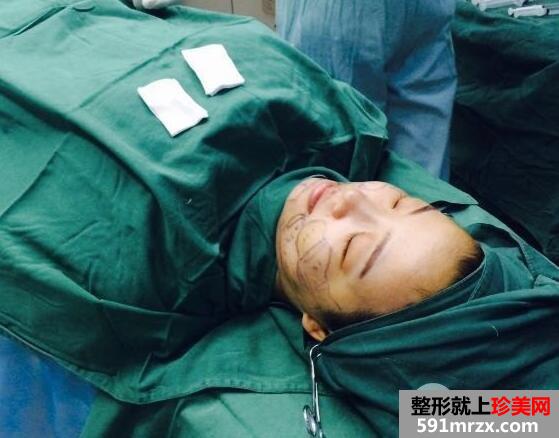 华美医院做的面部吸脂效果好恢复过程图和价格 真实案例