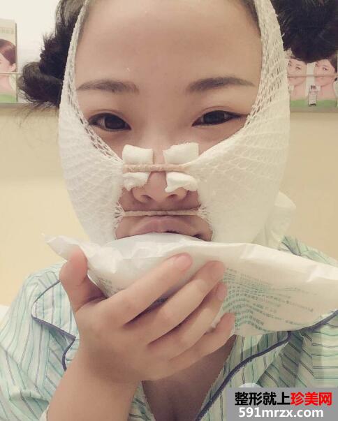 华美医院做的面部吸脂效果好恢复过程图和价格 真实案例