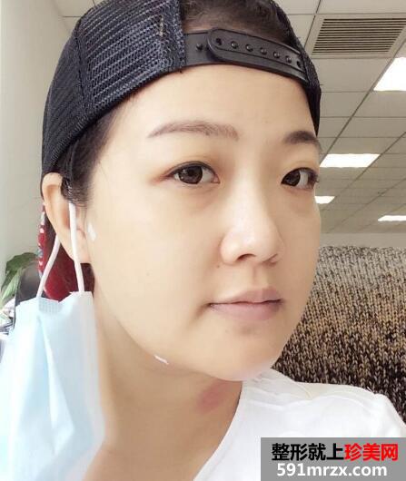 华美医院做的面部吸脂效果好恢复过程图和价格 真实案例