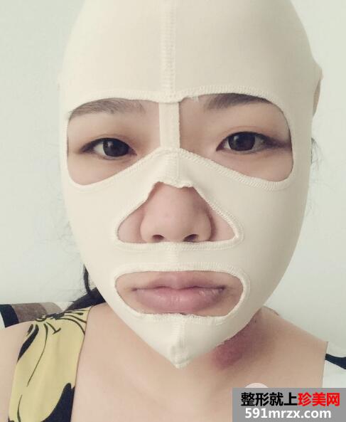 华美医院做的面部吸脂效果好恢复过程图和价格 真实案例