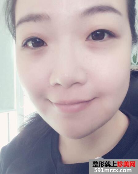 华美医院做的面部吸脂效果好恢复过程图和价格 真实案例