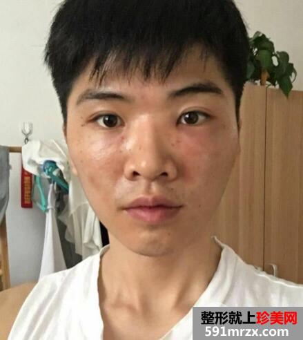 华美整形医院做的自体脂肪丰苹果肌前后对照图案例