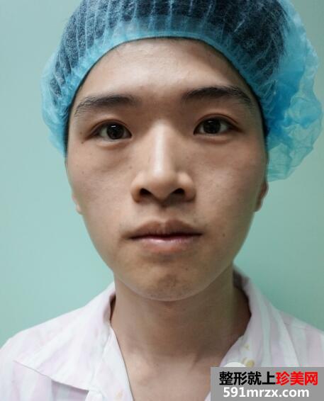 华美整形医院做的自体脂肪丰苹果肌前后对照图案例