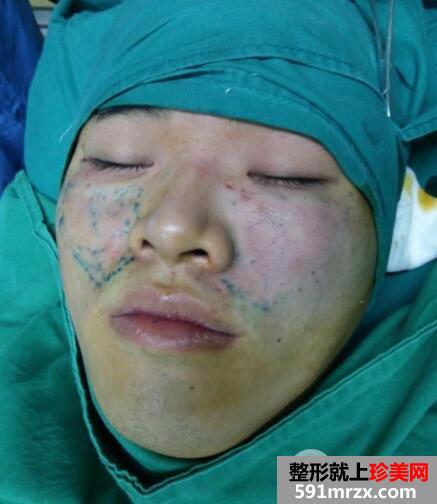 华美整形医院做的自体脂肪丰苹果肌前后对照图案例