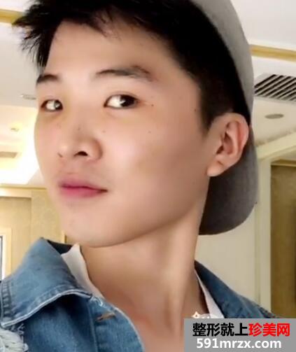 华美整形医院做的自体脂肪丰苹果肌前后对照图案例