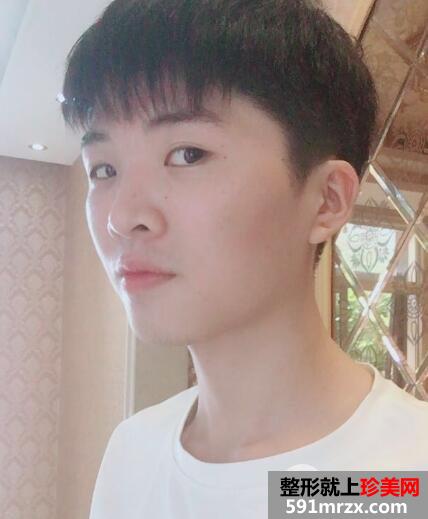 华美整形医院做的自体脂肪丰苹果肌前后对照图案例