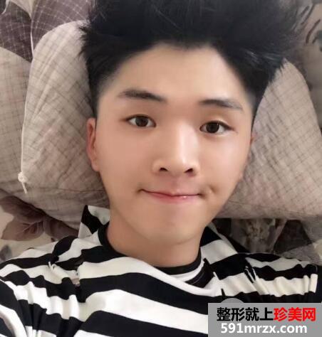 华美整形医院做的自体脂肪丰苹果肌前后对照图案例