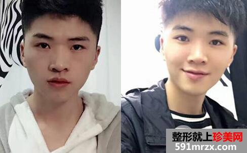 华美整形医院做的自体脂肪丰苹果肌前后对照图案例