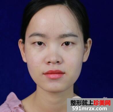 美莱医院做的割双眼皮开眼角价格和恢复过程图 真实案例