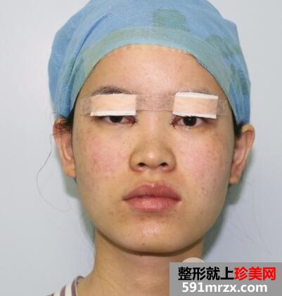 美莱医院做的割双眼皮开眼角价格和恢复过程图 真实案例