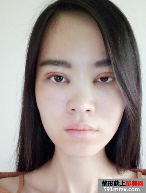 美莱医院做的割双眼皮开眼角价格和恢复过程图 真实案例