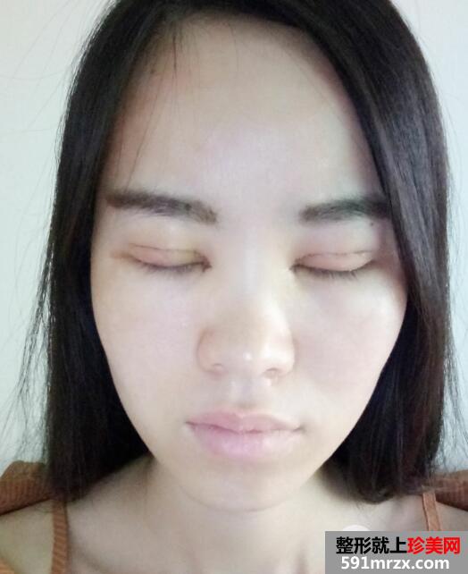 美莱医院做的割双眼皮开眼角价格和恢复过程图 真实案例