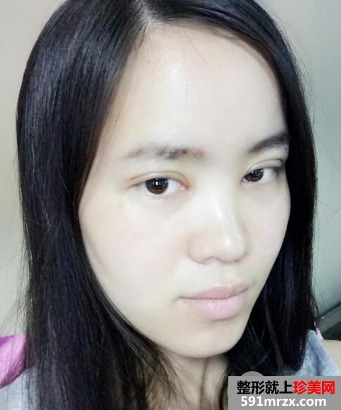 美莱医院做的割双眼皮开眼角价格和恢复过程图 真实案例