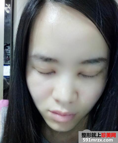 美莱医院做的割双眼皮开眼角价格和恢复过程图 真实案例