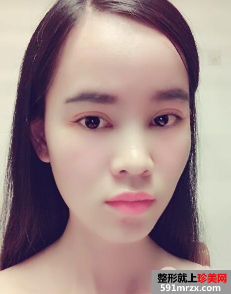 美莱医院做的割双眼皮开眼角价格和恢复过程图 真实案例