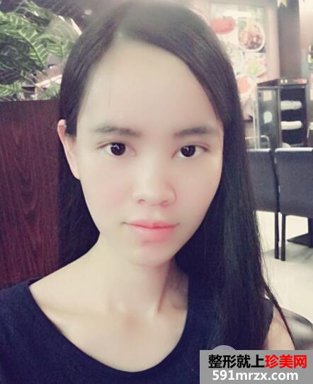 美莱医院做的割双眼皮开眼角价格和恢复过程图 真实案例
