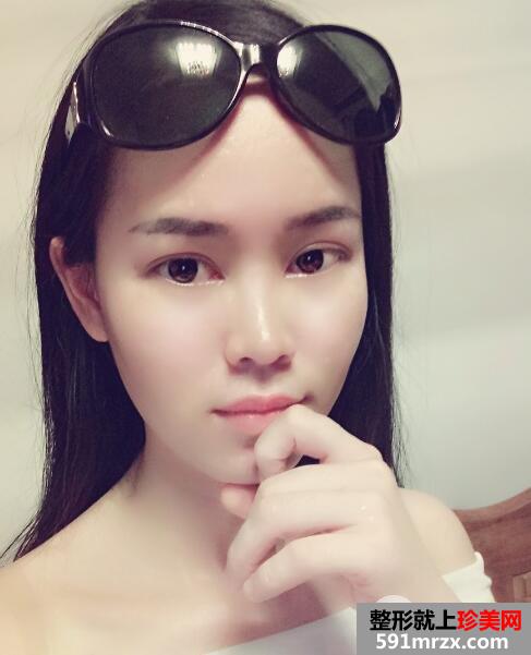美莱医院做的割双眼皮开眼角价格和恢复过程图 真实案例