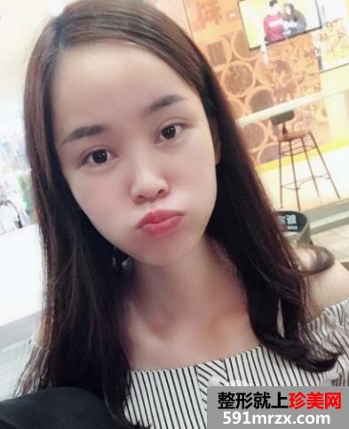 美莱医院做的割双眼皮开眼角价格和恢复过程图 真实案例