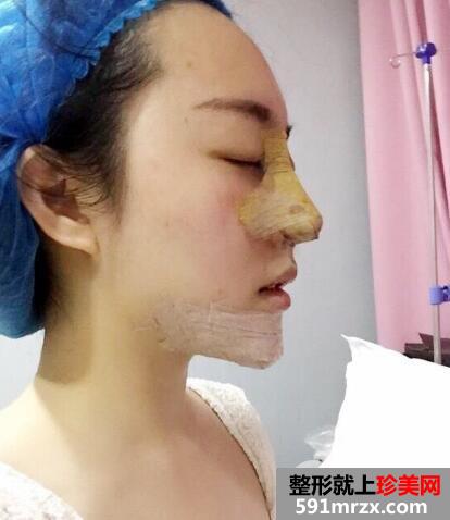 硅胶假体隆鼻和垫下巴价格适宜效果好 真实案例