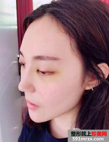 硅胶假体隆鼻和垫下巴价格适宜效果好 真实案例