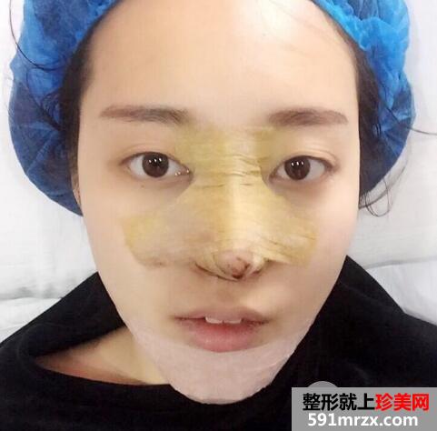 硅胶假体隆鼻和垫下巴价格适宜效果好 真实案例