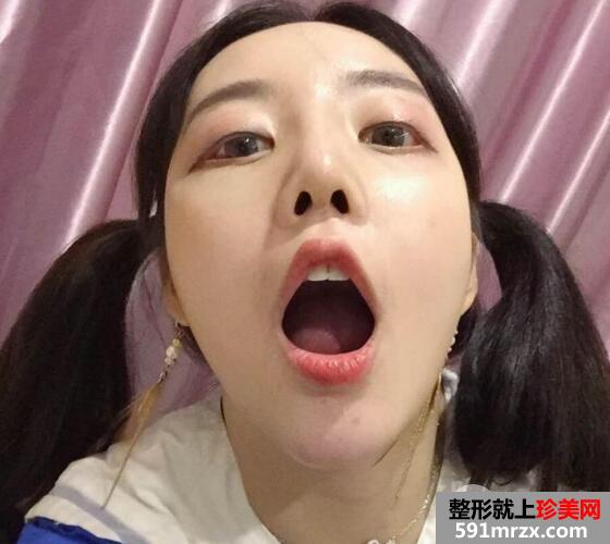 硅胶假体隆鼻和垫下巴价格适宜效果好 真实案例