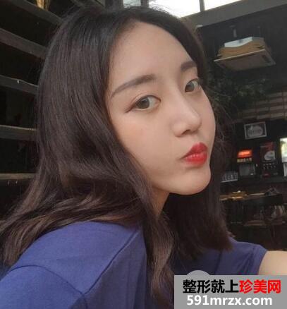 硅胶假体隆鼻和垫下巴价格适宜效果好 真实案例