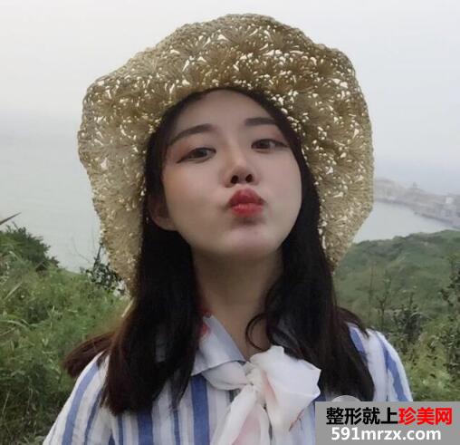硅胶假体隆鼻和垫下巴价格适宜效果好 真实案例