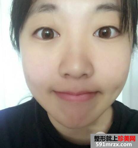 割双眼皮哪家医院好?去壹加壹整形医院做了双眼皮手术案例