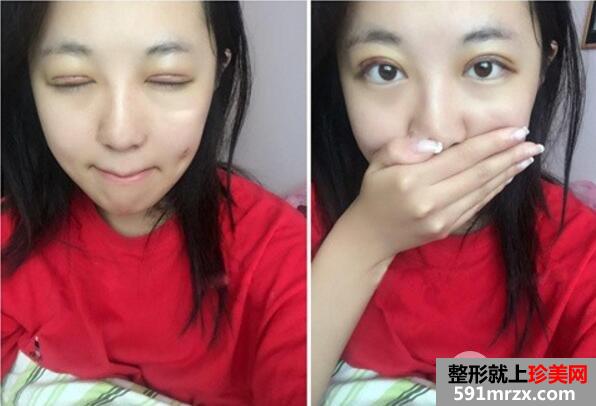 割双眼皮哪家医院好?去壹加壹整形医院做了双眼皮手术案例