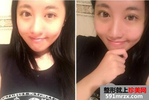 割双眼皮哪家医院好?去壹加壹整形医院做了双眼皮手术案例